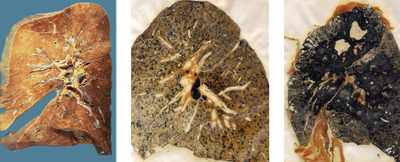 Left to right: Health lung tissue, simple black lung disease, complicated black lung disease.